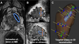 Hệ thống sinh thiết tuyến tiền liệt dưới hướng dẫn siêu âm kết hợp hình ảnh MRI